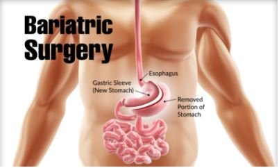 best baiatric surgery in hyderabad