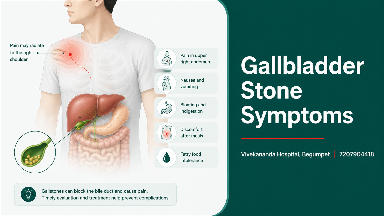 Gallbladder stone symptoms: upper right abdominal pain radiating to the right shoulder, nausea and bloating